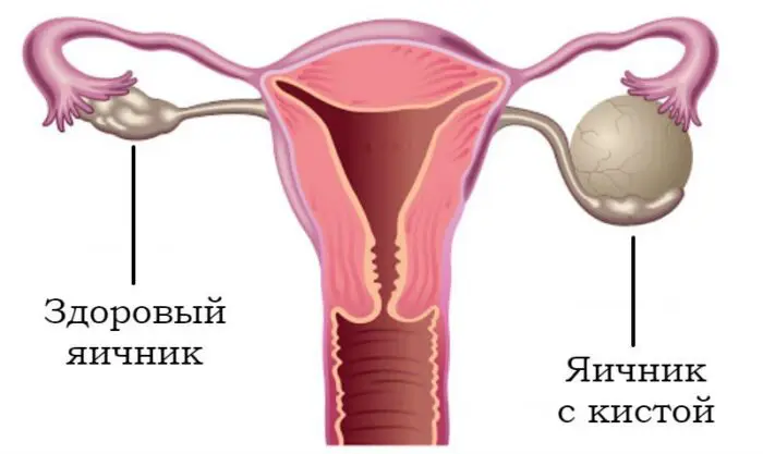 Кіста яєчника