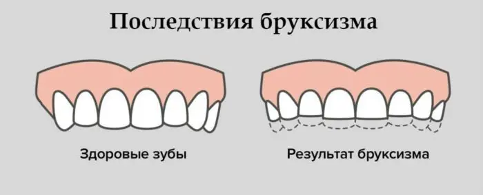 Из-за бруксизма стачиваются зубы