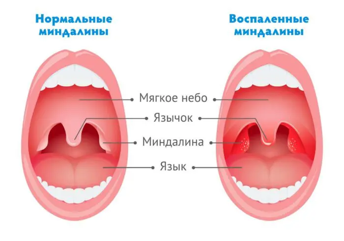 Как выглядят здоровые и воспаленные миндалины