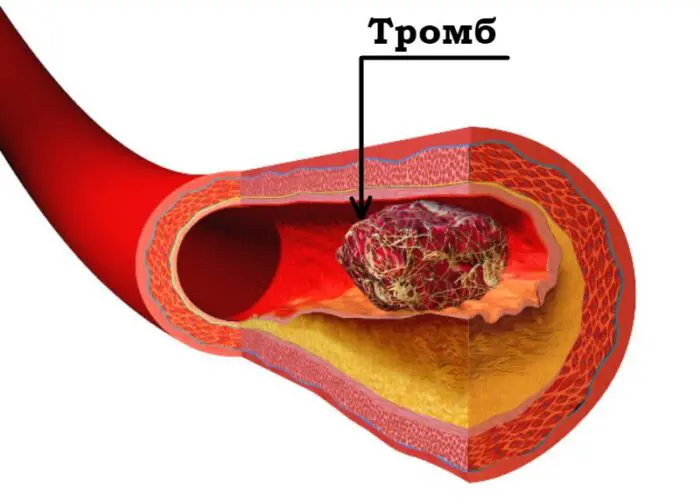 Тромб