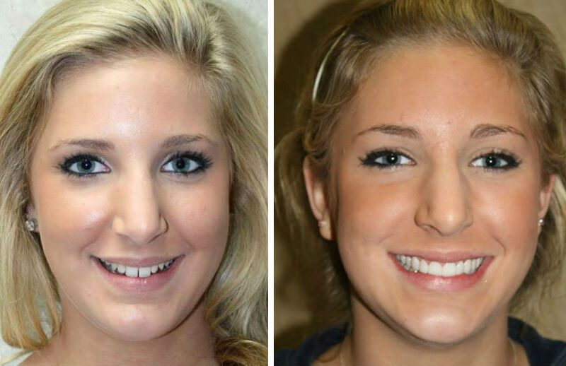 Виниры до и после фото девушек