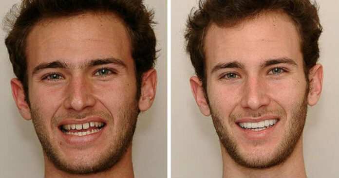 Посмішка до і після вінірів
