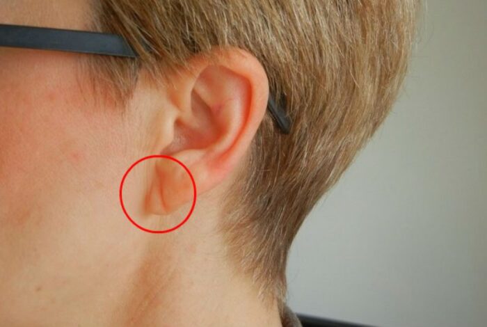 Характерная складка на мочке уха