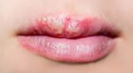 Как выглядит герпес на губах, как его лечить и когда без врача не обойтись (2) 