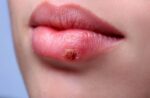 Как выглядит герпес на губах, как его лечить и когда без врача не обойтись (5) 