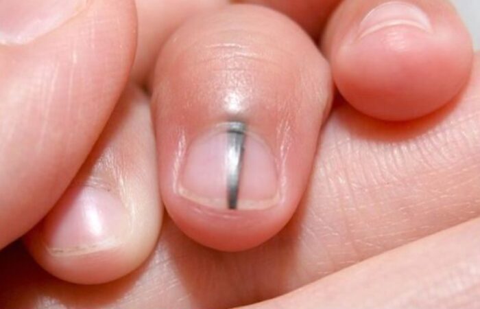 Так выглядит меланома ногтя