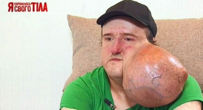 Олег жил с огромной опухолью на щеке долгих 10 лет
