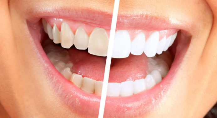 Чому зуби жовтіють і як їх відбілити в домашніх умовах: поради стоматологів 