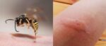 ТОП-10 фото, как выглядят укусы насекомых клещи, мошки, клопы, осы, блохи и другие (5) 