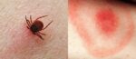 ТОП-10 фото, как выглядят укусы насекомых клещи, мошки, клопы, осы, блохи и другие (7) 