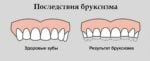 Действительно ли зубной скрежет во сне является признаком глистов (3) 