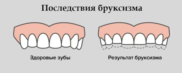 Из-за бруксизма стачиваются зубы