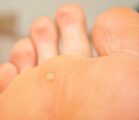 Callus and hyperkeratosis on sole of a foot at closeup 