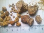 Kidney_stones_(_renal_calculi_),_Бубрежни_камења_5 