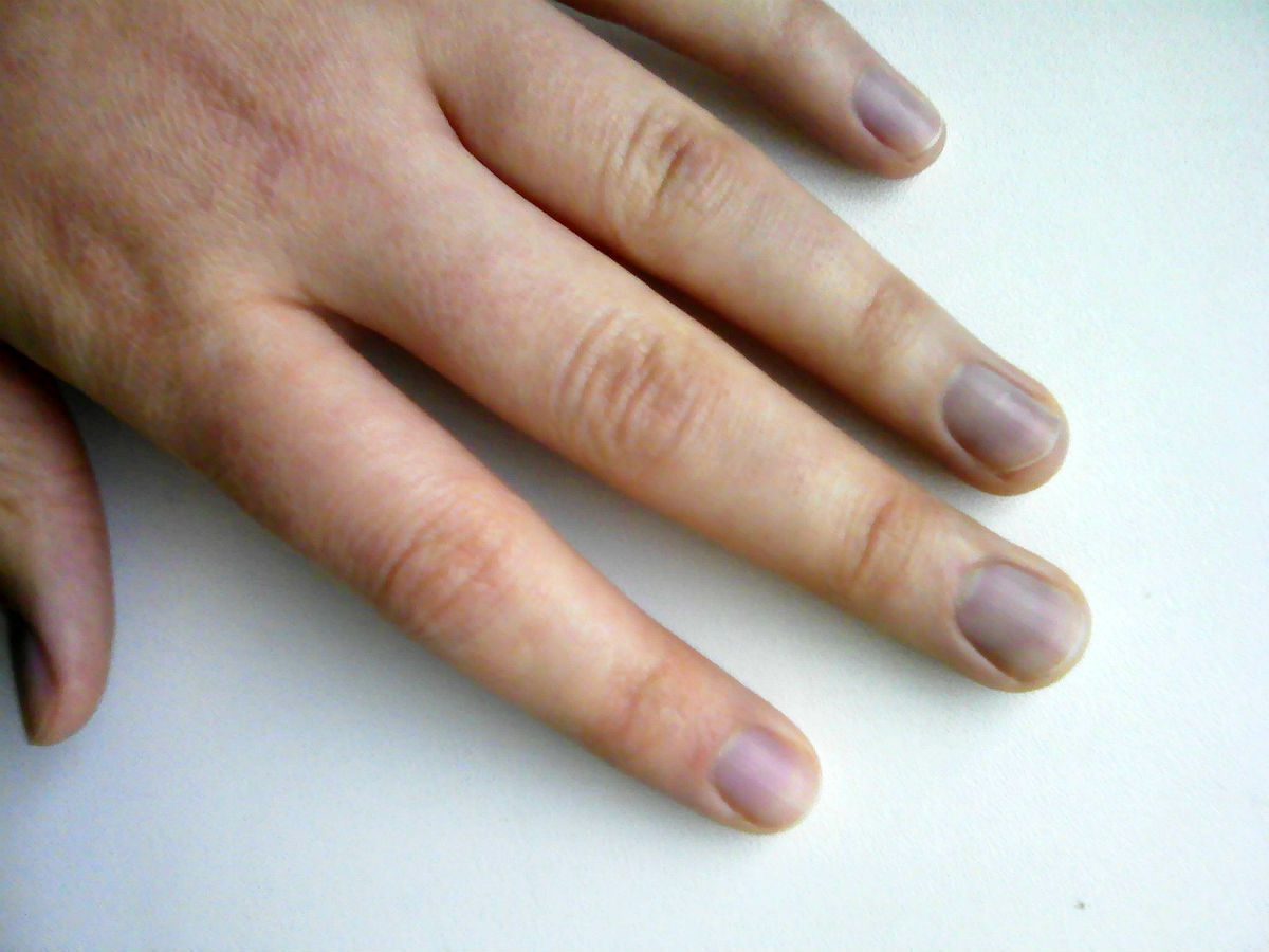 Бледные синюшные ногти на руках
