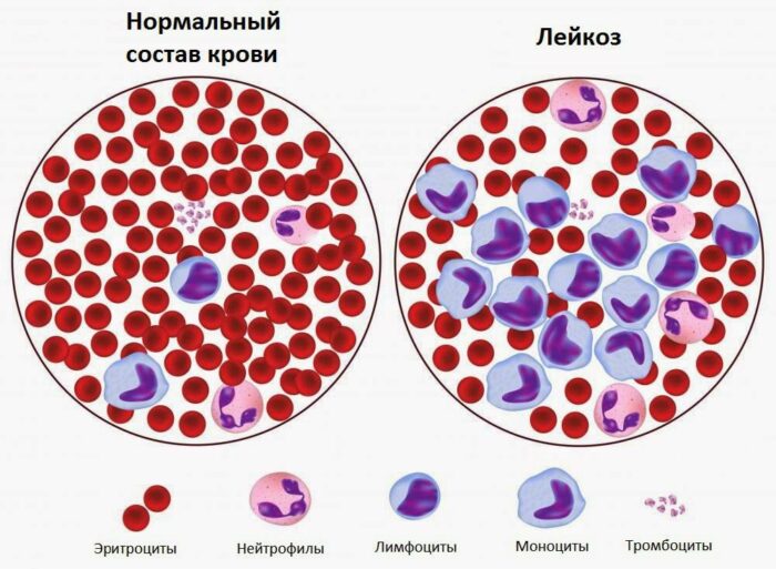 Как выглядит нормальная кровь и крови при лейкозе