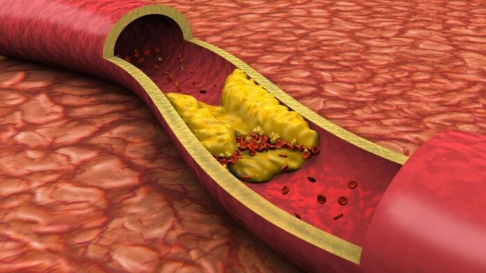 Холестерин на клетках сосудов