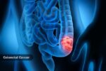 1800ss_getty_rf_colorectal_cancer 