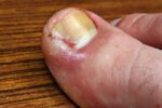 1800ss_getty_rf_ingrown_toenail 