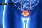 1800ss_science_source_rm_bladder_cancer 