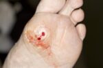 1800ss_sciencesource_rm_diabetic_foot_ulcer 