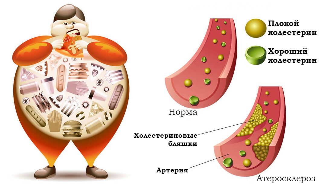 Высокий уровень холестерина