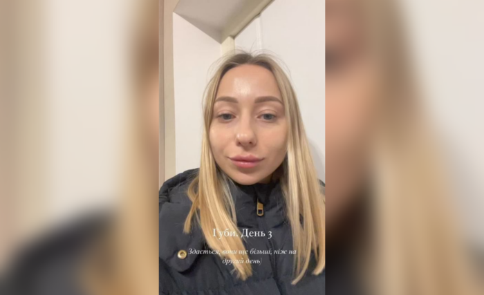 Катерина Репяхова показала як виглядає на третій день після збільшення губ