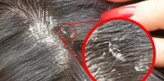 Експерти назвали дієвий спосіб виведення вошей у дітей