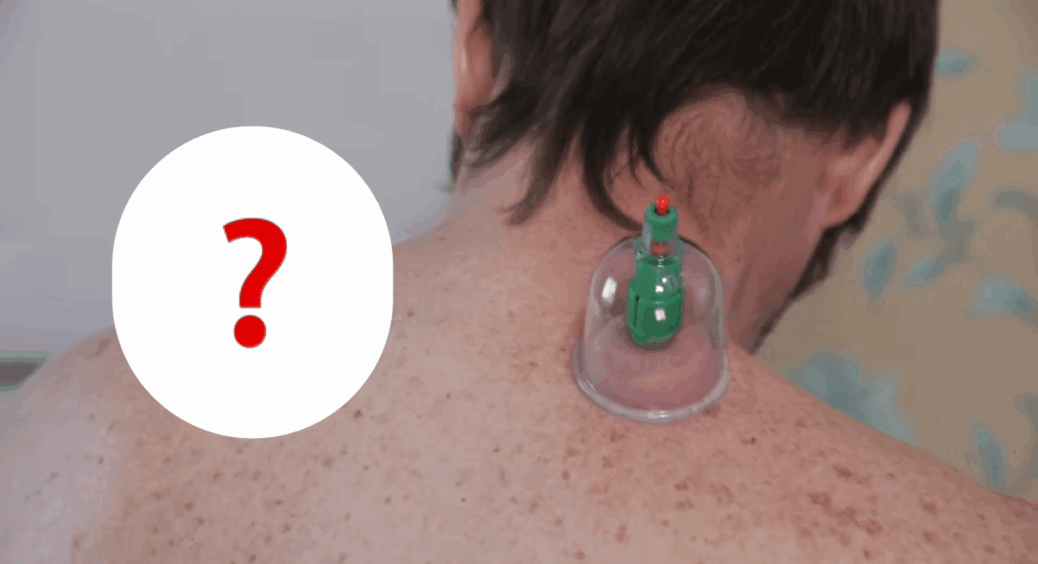 Банки на спину — “ЗА” і “ПРОТИ”: їх ставили роками, а чи дійсно в цьому є сенс? Спеціаліст розкрив правду 