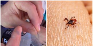 Господині розповіли, як дістати кліща зі шкіри за допомогою пляшки