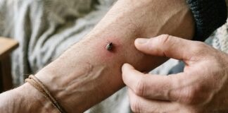 Лікарі розповіли, як правильно діяти у разі укусу кліща 